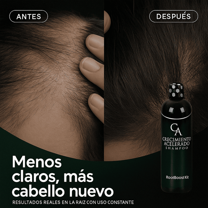 RootBoost Kit Anti-caída y crecimiento acelerado + 1 Karseell GRATIS