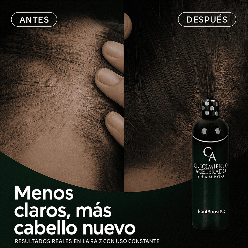 RootBoost Kit Anti-caída y crecimiento acelerado + 1 Karseell GRATIS